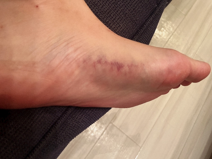 謎のあざパート2