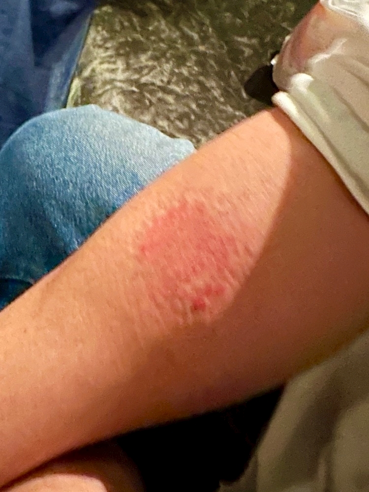 歯型記念日🦷(えりかの歯型ではない)